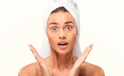 Akne (Sivilce) Nedir? Neden Oluşur?